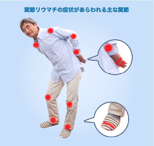 関節リウマチの原因